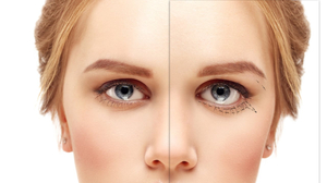 Canthoplasty in Korea | Kosten, Beste Klinieken, Procedure Details en meer over Laterale Canthoplasty!