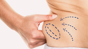 Liposuction in Singapore | Cost, Best Clinics and Best Alternatives