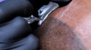 Scalp Micropigmentation in Korea: A Comprehensive Guide