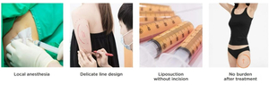Getting Fat Dissolving Injections in Korea incl. Which Clinics To Visit, Cost & More