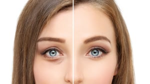 Blefaroplastik i Korea | Fullständig guide till övre och nedre blefaroplastik i Korea