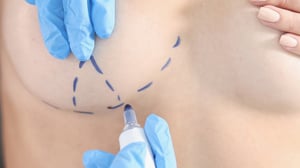 Bröstförminskning i Korea | Bästa Klinikerna, Kostnader, Procedurdetaljer och mer!