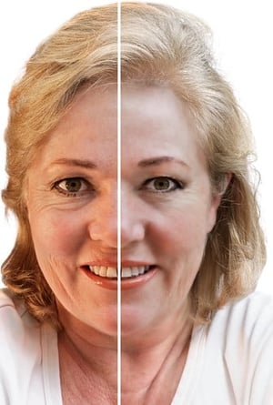 Facelift i Korea | Typer af Facelifts, Bedste Klinikker og Priser