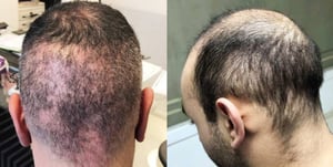 Hair Transplant Gone Wrong