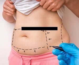 Best Liposuction Clinics in Seoul│Lydian Liposuction Clinic, Seojin, THE PLUS, 365mc and more