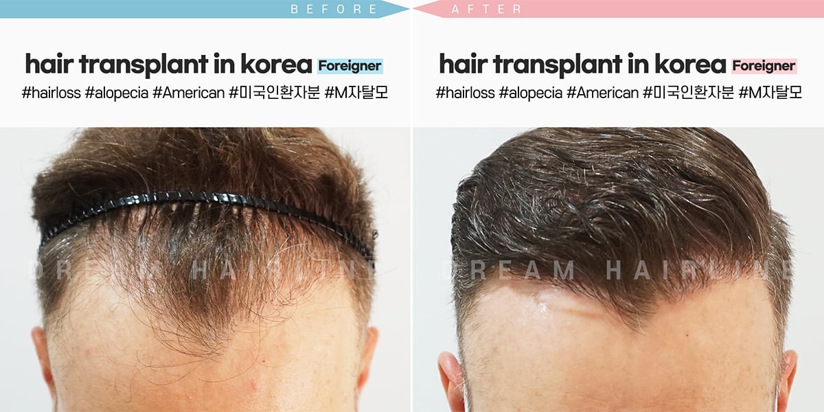 1 Day Hair Transplant Seoul Korea