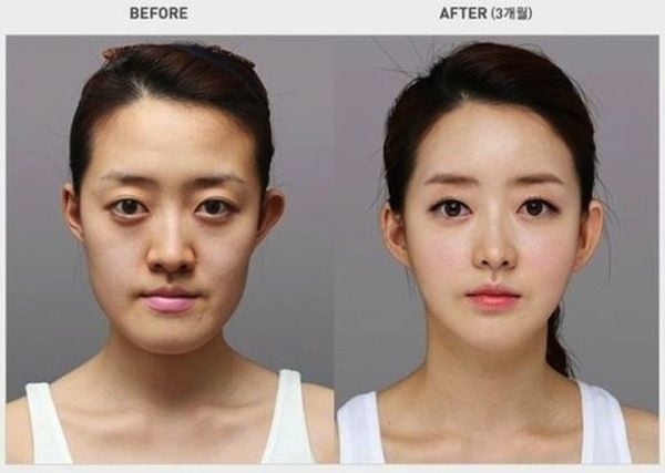 kpop plastic surgery