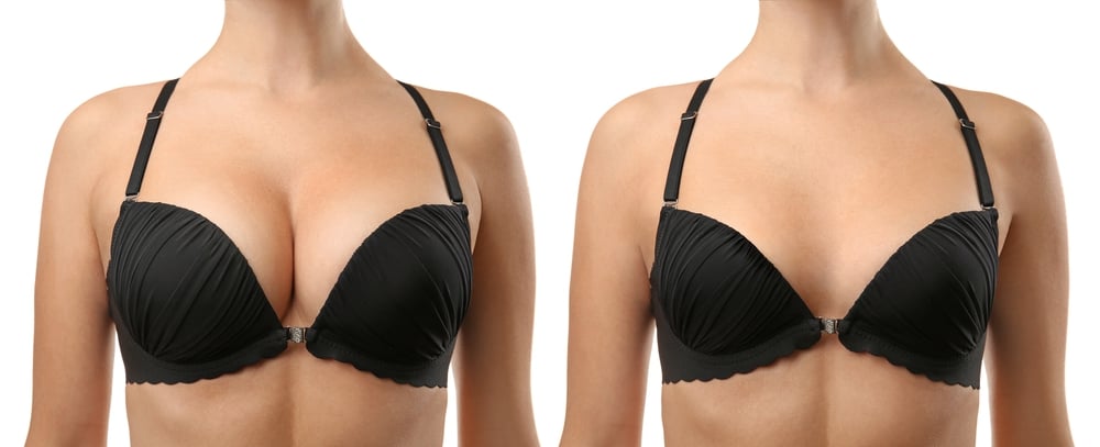 Can Breast Augmentation Help Correct Asymmetry ? – Premier Surgical Arts