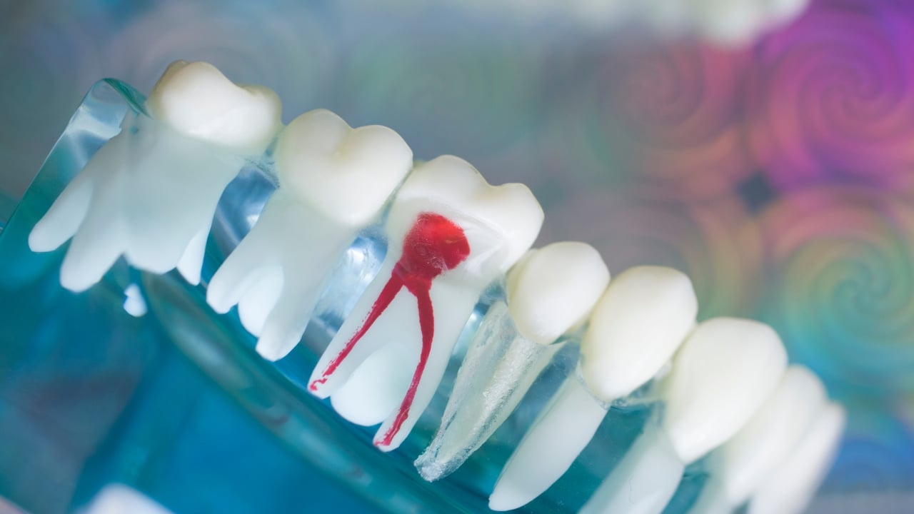 Getting A Root Canal in Korea | What Is It? How Much Does It Cost? Best Korean Dental Clinics