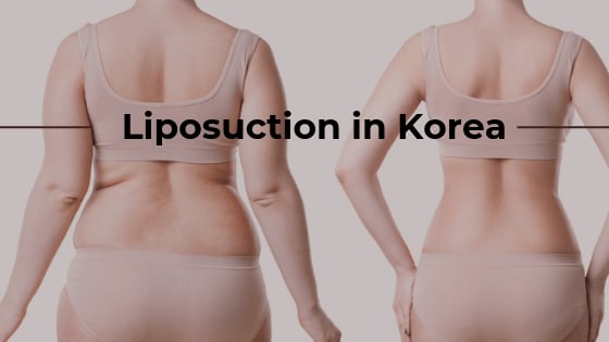 Liposuction in Seoul, Korea