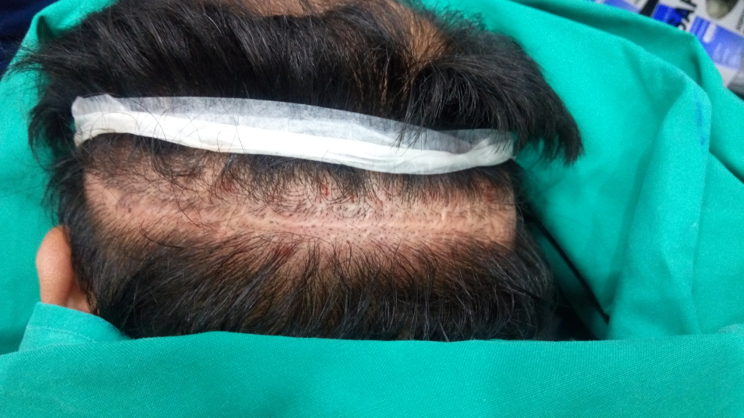 Parietal hair transplant with a wide range of hair loss...Scalp tattooing also helps