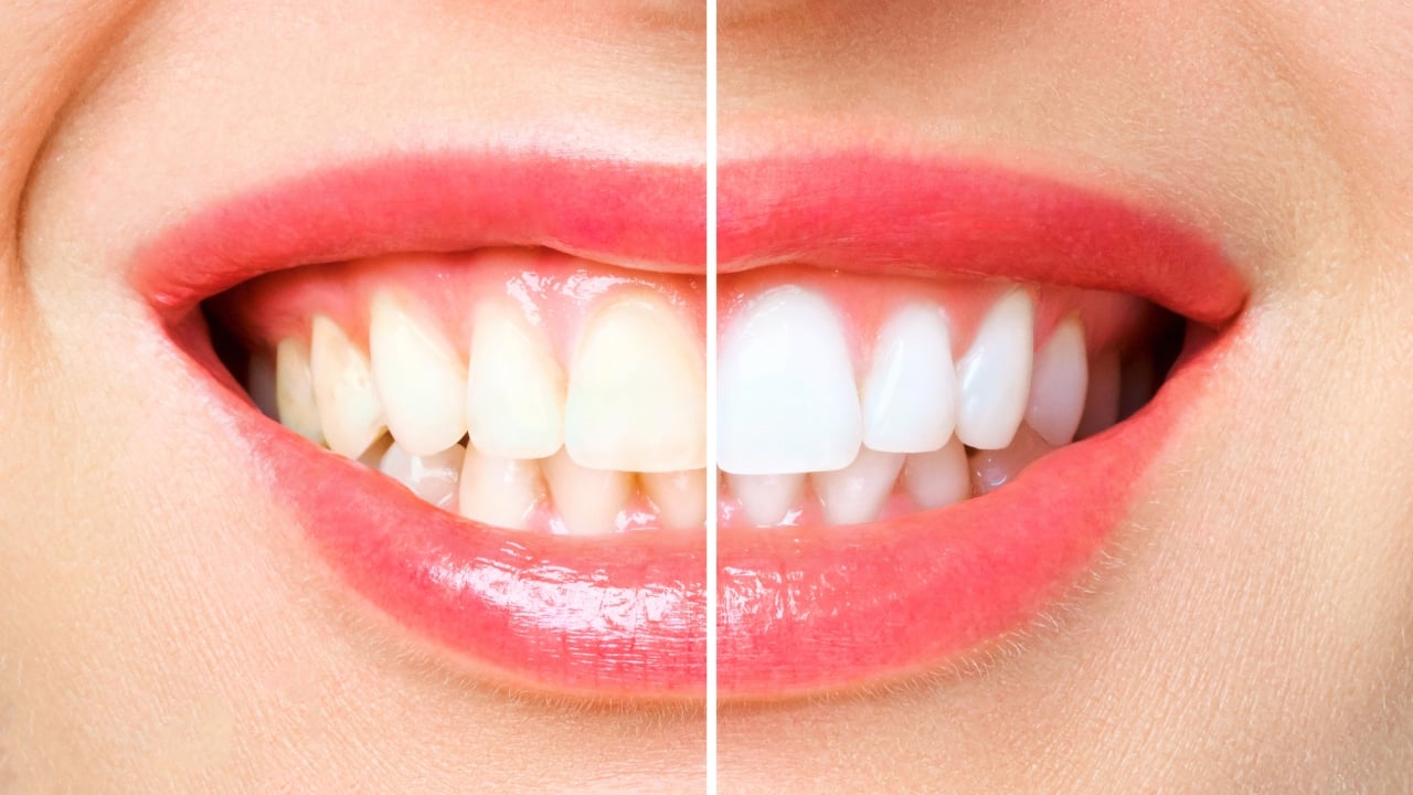 Teeth Whitening in Korea | What Is It? How Much Does it Cost? Which Dental Clinic To Go To!