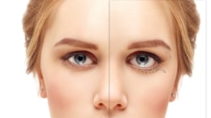 Canthoplasty in Korea | Costs, Best Clinics, Procedure Details and more about Lateral Canthoplasty!