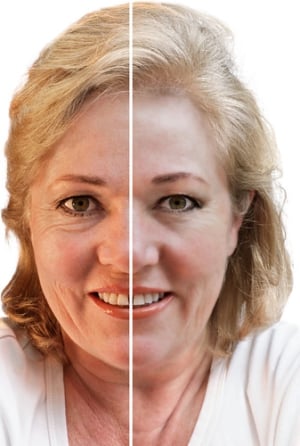 Facelift in Korea | Types of Facelifts, Best Clinics & Prices