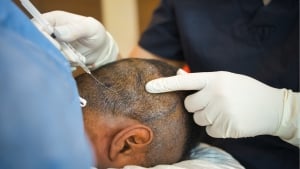 Hair Transplant in Singapore | Cost, Best Clinics & Alternatives