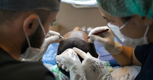 Navigating Hair Transplant Recovery: A Week-by-Week Guide