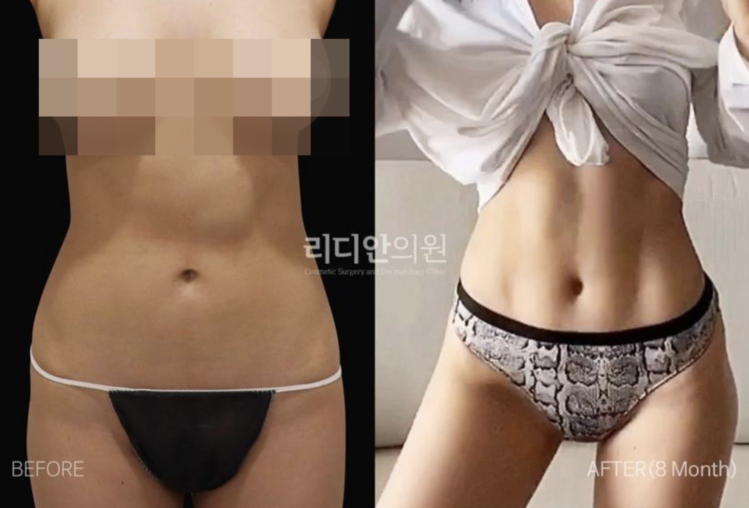 plastic surgery hospital in korea