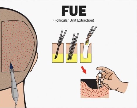 fue-hair-transplant-korea