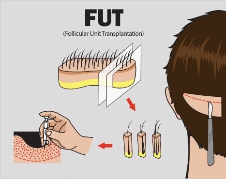 fut-hair-transplant-korea