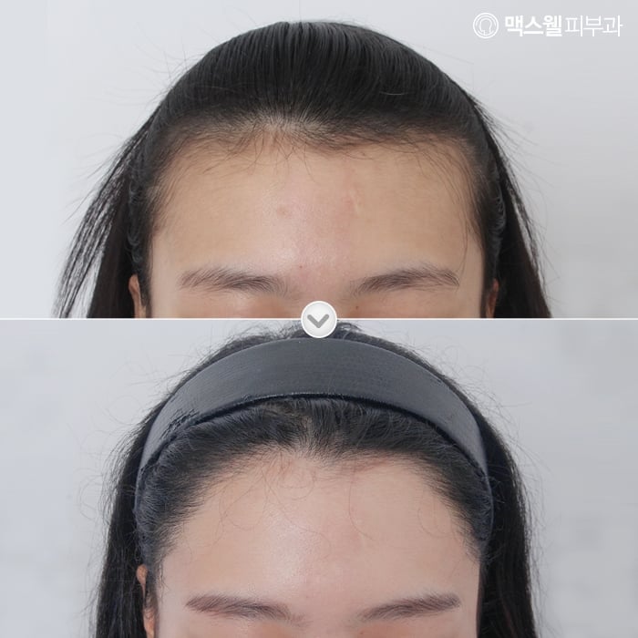 female hair transplant before after korea