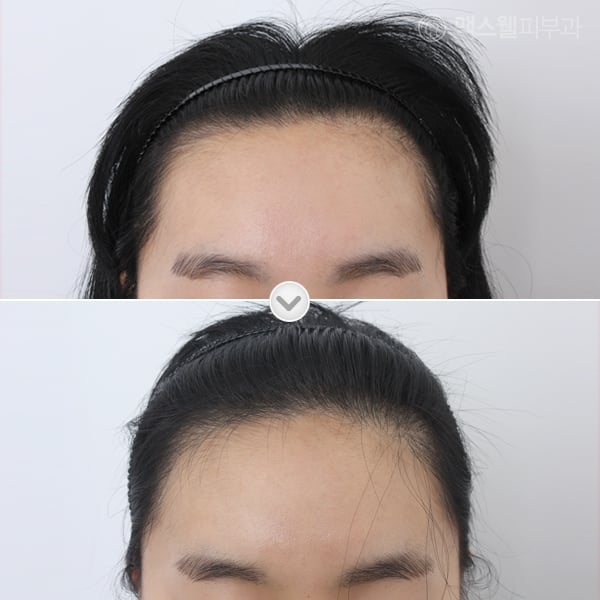 woman hair transplant before after korea