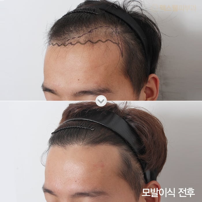 male hair transplant before after korea