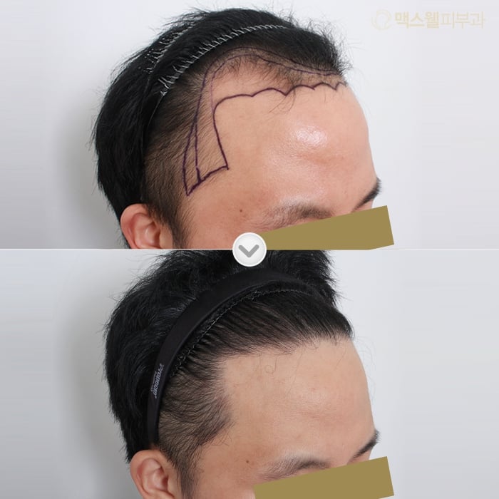 Expert Hair Transplant and Restoration Solutions for Women in India