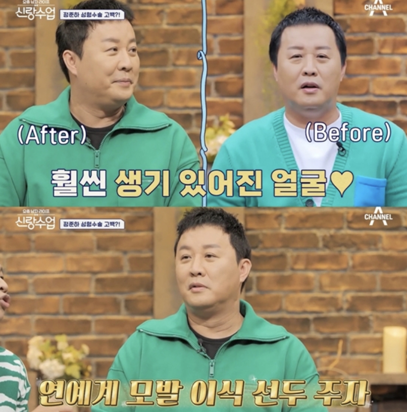 jeong jooon ha hair transplant
