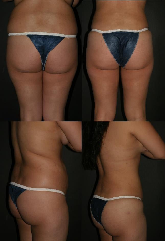 An image portraying the before and after results of bbl surgery