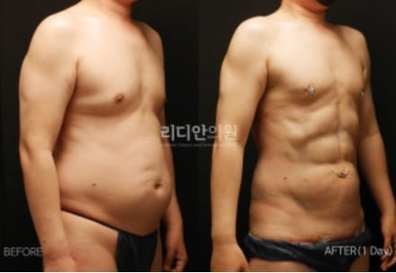 An image depicting body contouring before and after