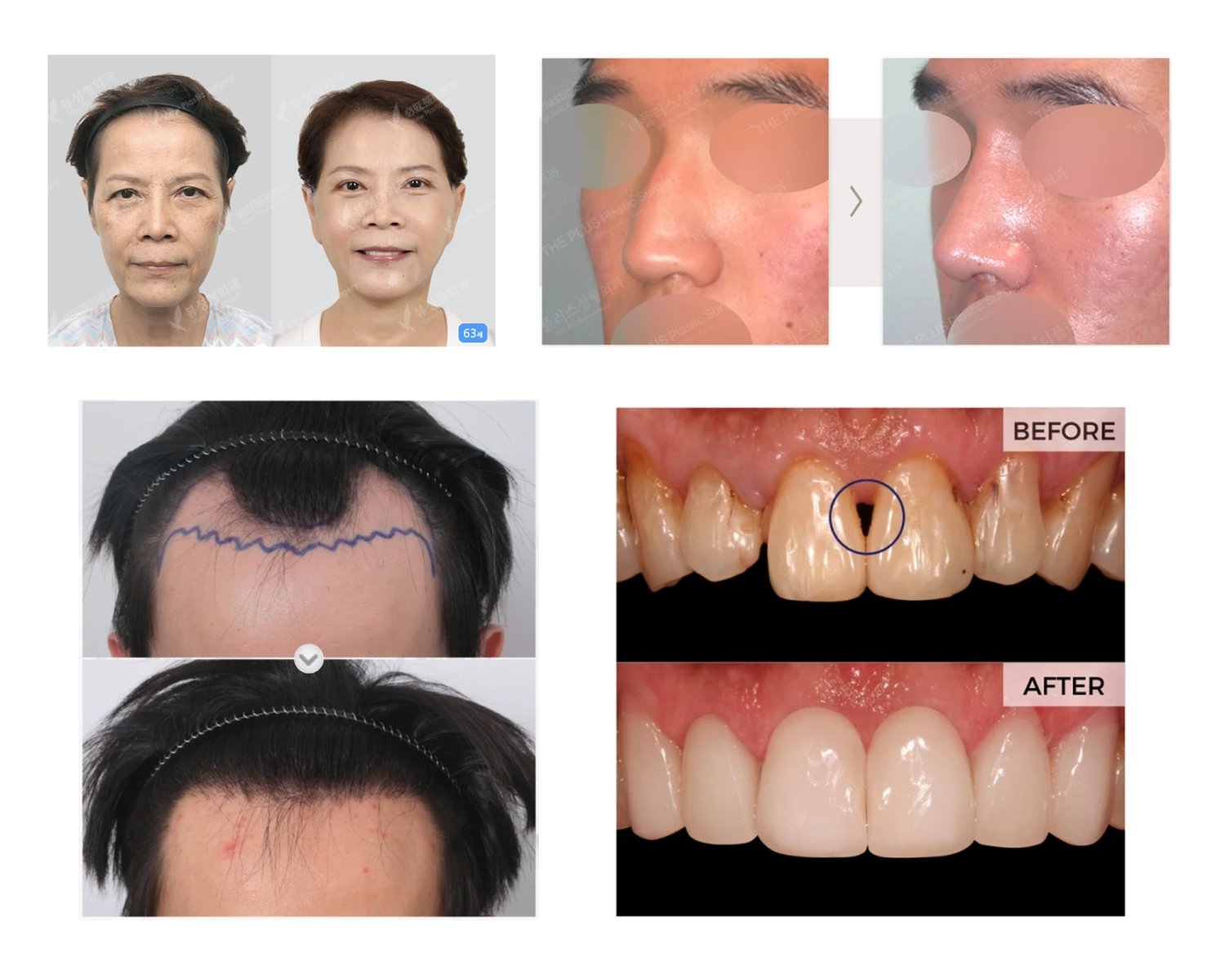 collection of surgery before and after photos from South Korea