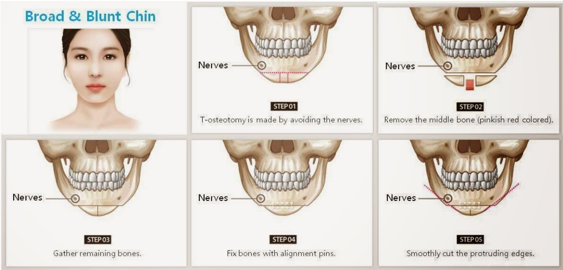 what is Korean v line surgery?