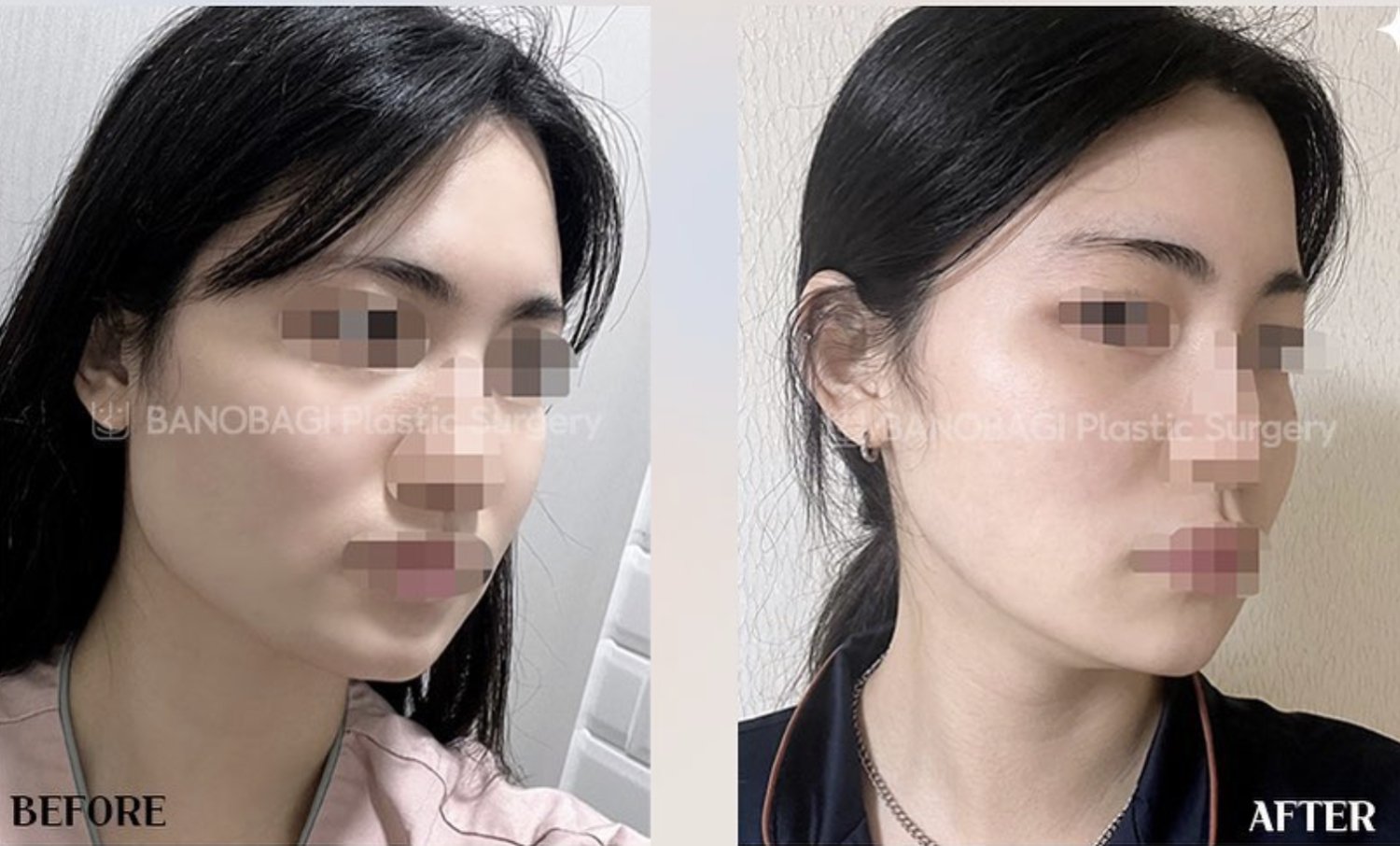 korean plastic surgery before and after jaw