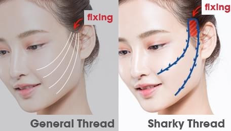 thread lift in korea lydian plastic surgery clinic