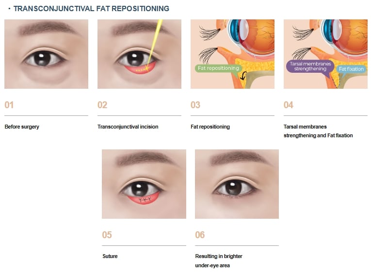 blepharoplasty korea