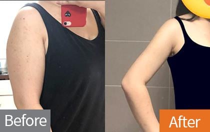 fat-dissolving-injections-before-and-after2