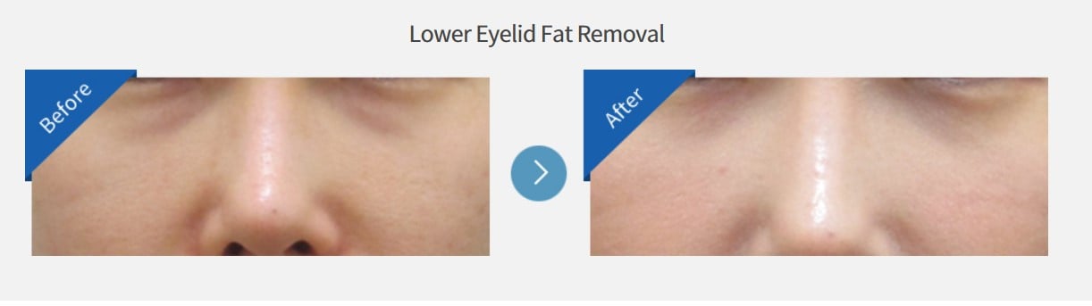 lower eyelid fat removal korea
