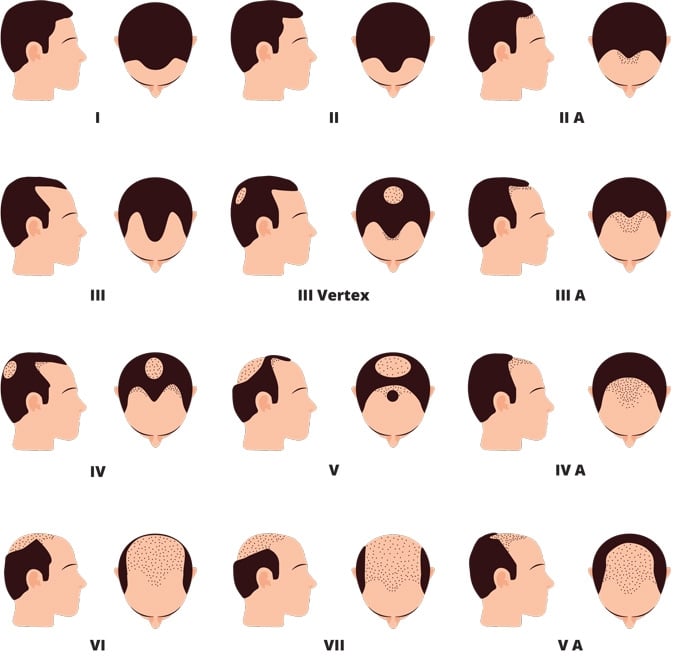 the-hamilton-norwood-scale