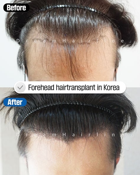 dreamhairline-1day-hair-transplant-before-and-after3