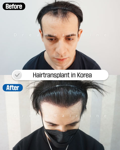 dreamhairline-1day-hair-transplant-before-and-after2