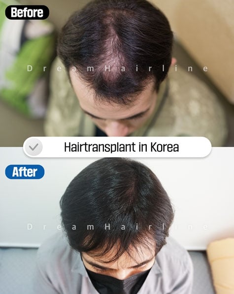 dreamhairline-1day-hair-transplant-before-and-after4