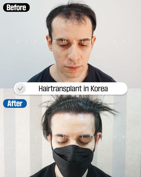 dreamhairline-1day-hair-transplant-before-and-after