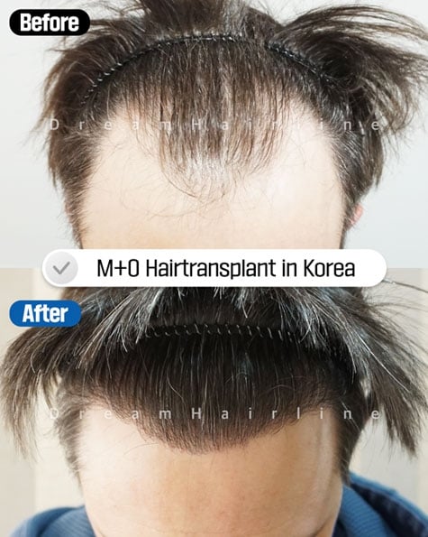 man hair transplant before after korea