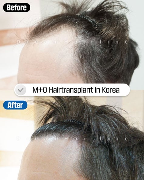 male hair transplant before after korea