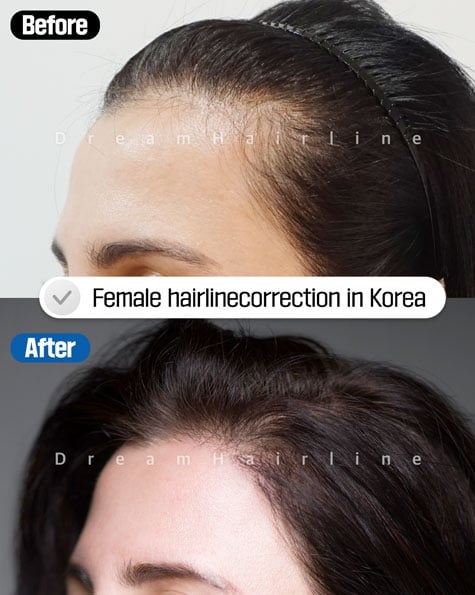 woman hair transplant before after korea