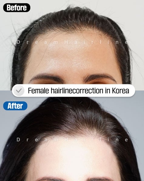 female hair transplant before after korea