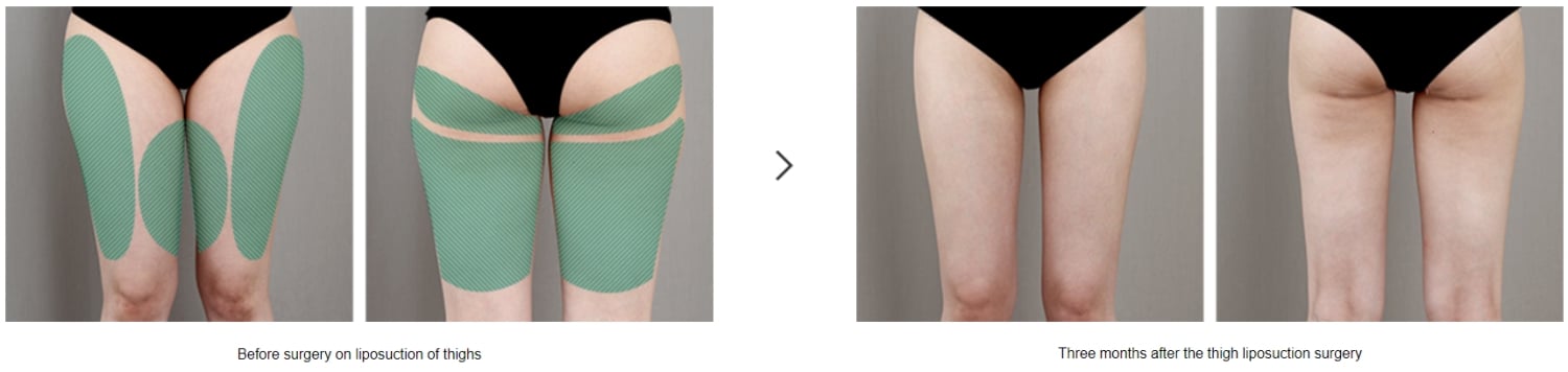 thigh liposuction cost korea