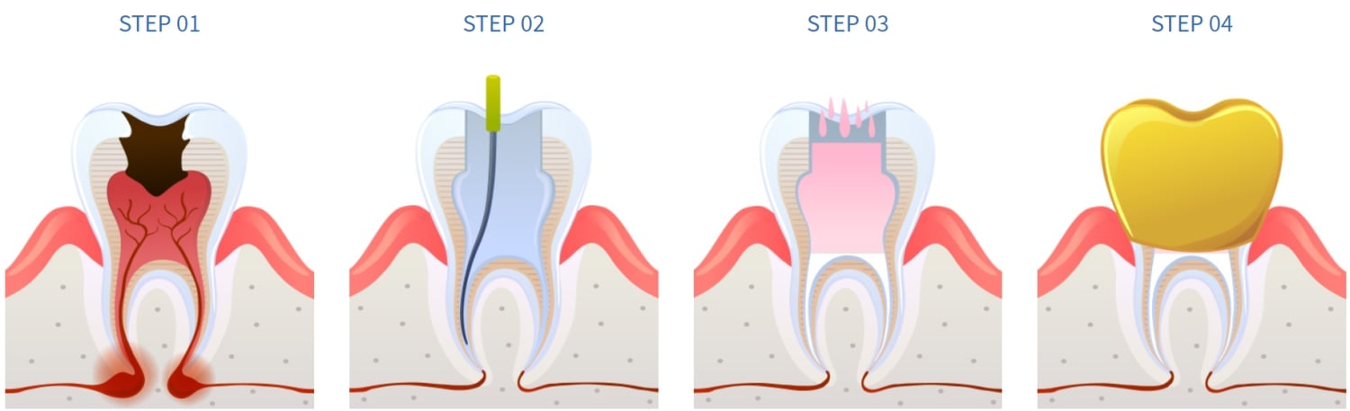 root canal procedure korea