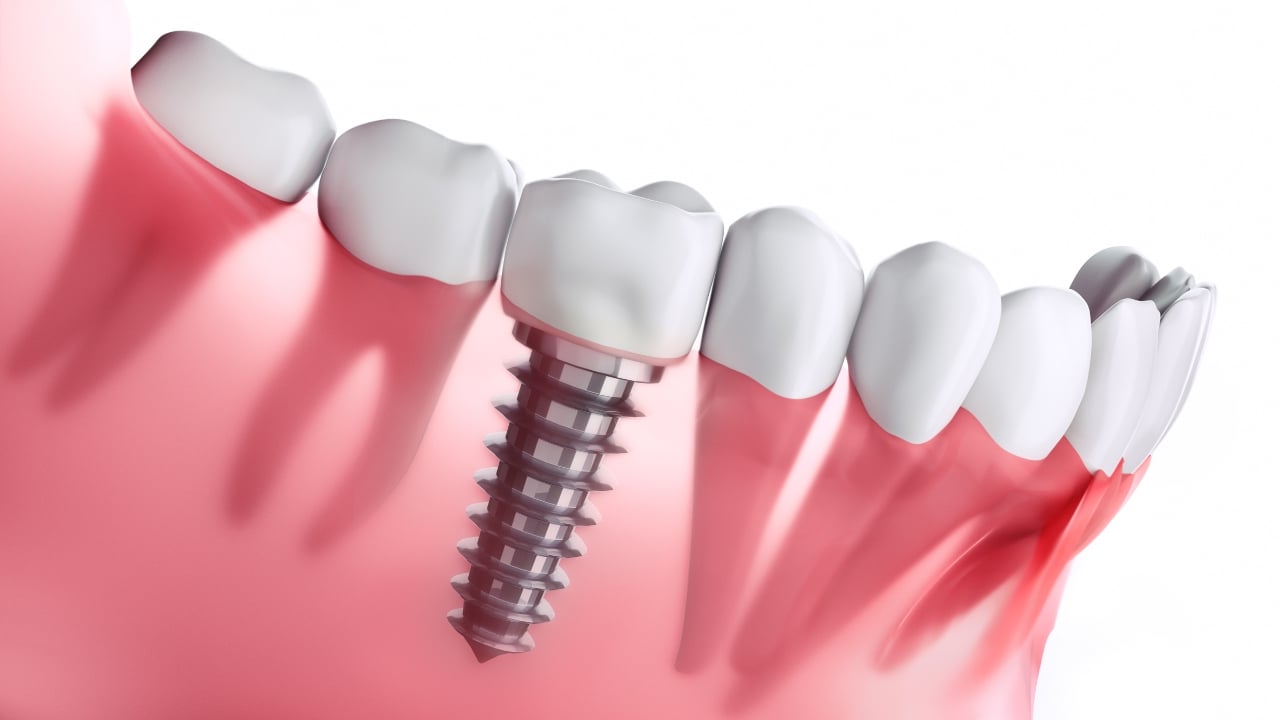 dental implants in korea