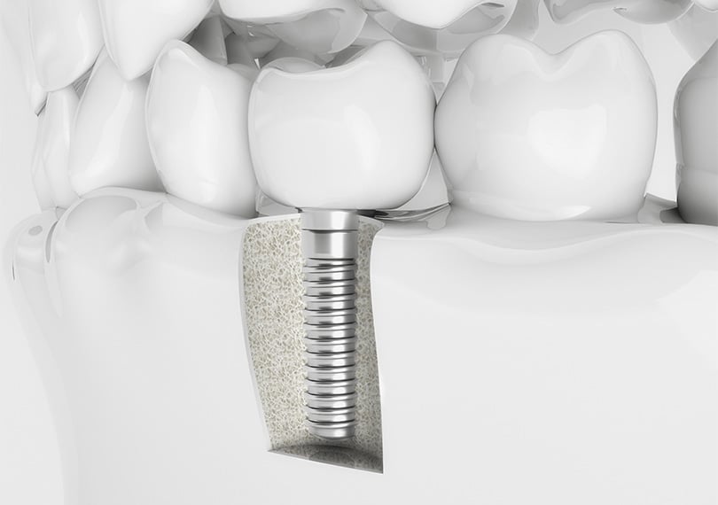 korean dental implant cost